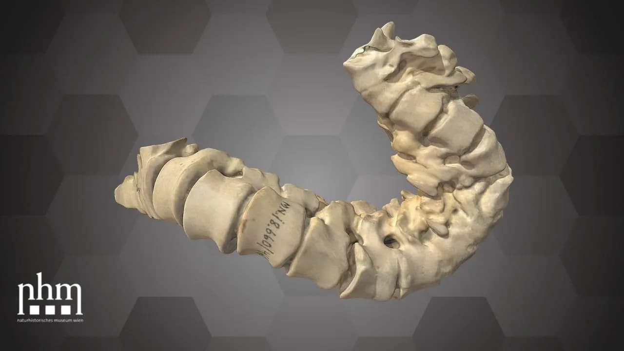 STL - Columnas vertebrales con cifosis