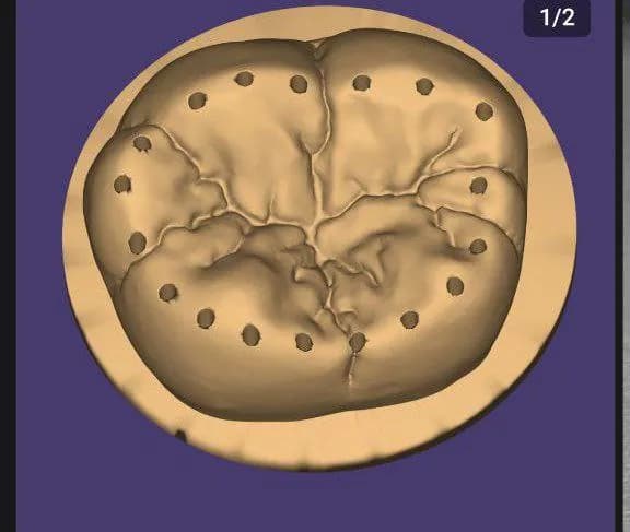 STL - Molar dental para impresión 3D